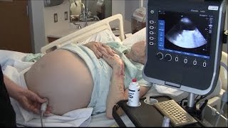 Ultrasound for Paracentesis  BAVLS [upl. by Alleunamme]