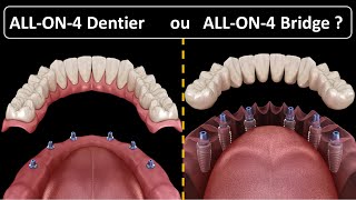 All on 4  Type de prothèse  Dentier ou Bridge [upl. by Kosey]