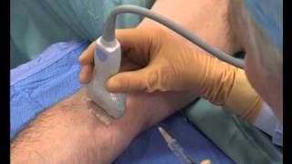 Median Nerve Block Ultrasound guided [upl. by Markiv]