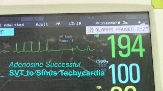 SVT or Supraventricular Tachycardia [upl. by Shear]