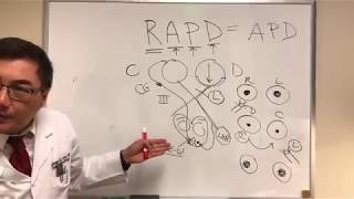 RAPD Relative Afferent Pupillary Defect MarcusGunn pupil [upl. by Sirret]