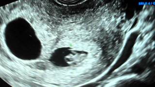 8 week ultrasound TWINS with heartbeats IVF [upl. by Llenaej]