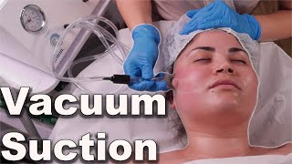 Vacuum suction facial treatment  avoid pore bruising step by step demo 2021 [upl. by Duquette132]