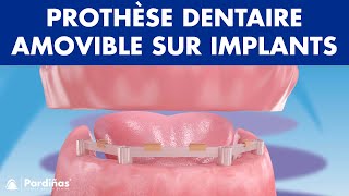 Prothèse dentaire amovible sur implants © [upl. by Ashwell]