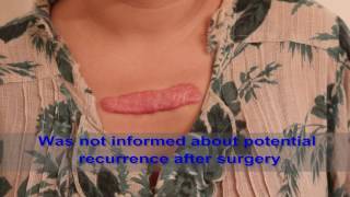 Chest Keloids  Mistakes to Avoid [upl. by Irrot414]