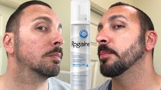 How to grow a REAL Beard  Minoxidil 4 Month Beard Journey [upl. by Doris]