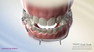 Tandem Appliance  Orthodontic Treatment [upl. by Einahpit]