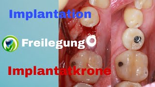 Zahnimplantation Freilegung Abformung Implantatkrone  Ablauf  Zeitraum  Dauer  Termine [upl. by Scarrow486]