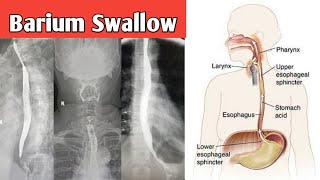 Barium Swallow complete study and technique and cases review [upl. by Mahala]