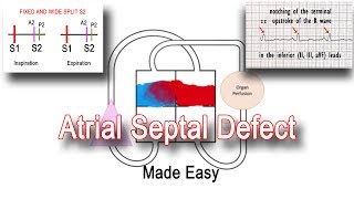 Atrial Septal Defect ASD Pathophysiology amp Clinical Features [upl. by Eanyl918]