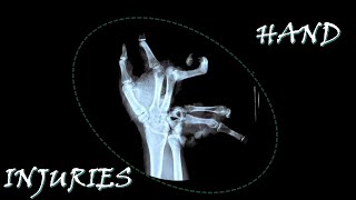 Hand Injuries [upl. by Ryhpez]