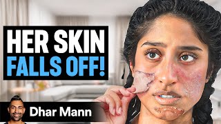 Girl Whose SKIN FALLS OFF  Dhar Mann Studios [upl. by Manlove]